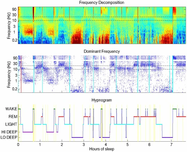 Wie Funktioniert Das Schlaf-Eeg?